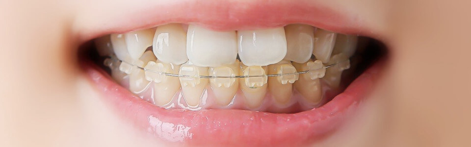 大阪で歯列矯正をお考えの方へ！初期費用・総額・費用を抑えるコツを解説
